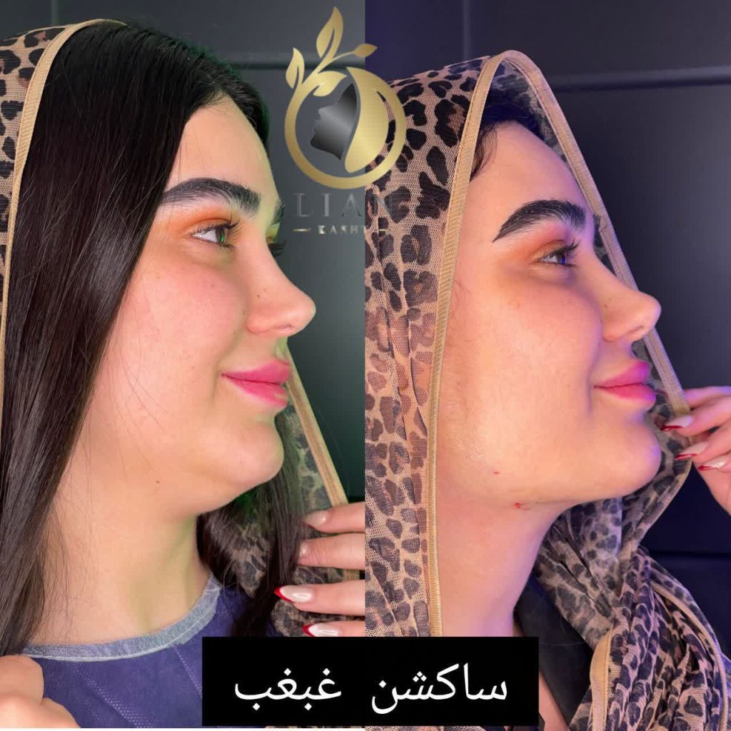 ساکشن غبغب و بوکال فت
