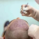 هیر کلینیک خدمات کاشت مو و ابرو در تهران قلهک