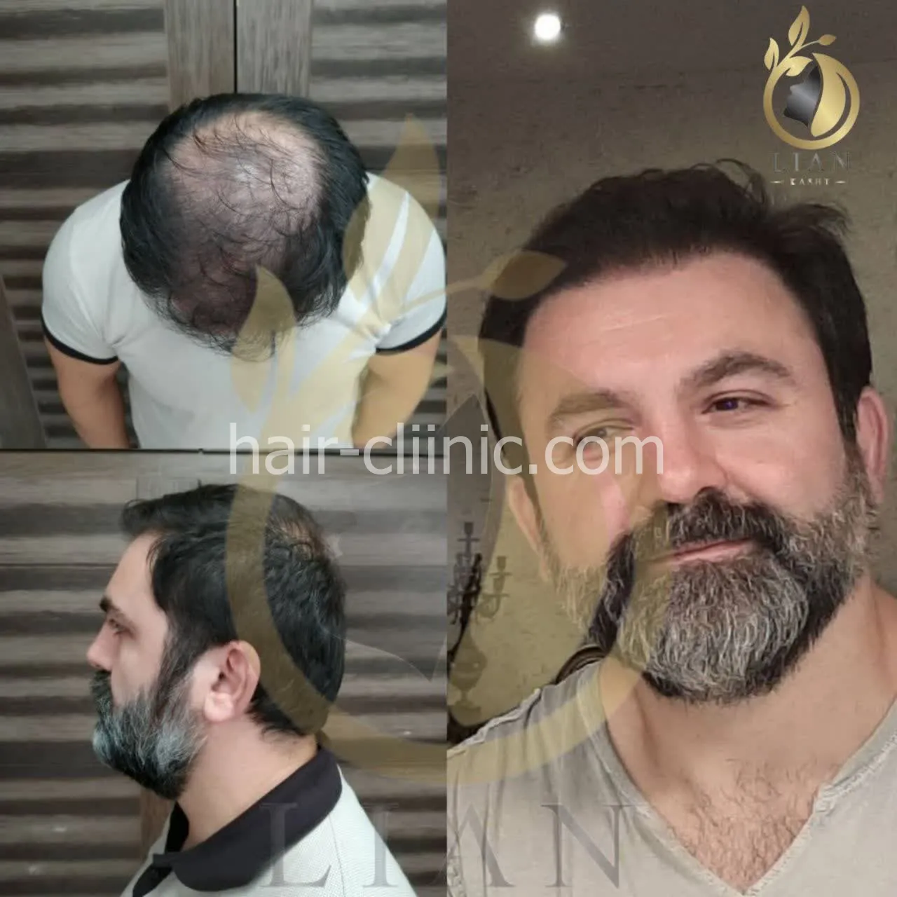 کاشت مو و ابرو در تهران