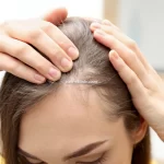 خدمات کاشت مو و ابرو FIT در تهران