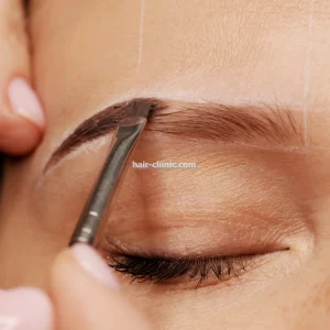 کاشت مو و ابرو با تراکم بالا در تهران