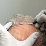 کاشت مو و ابرو برای اصلاح فرم ابرو در تهران