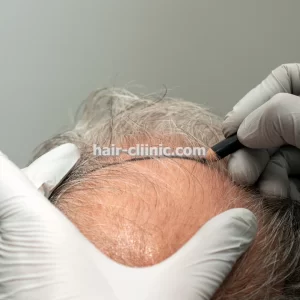 کاشت مو و ابرو برای اصلاح فرم ابرو در تهران