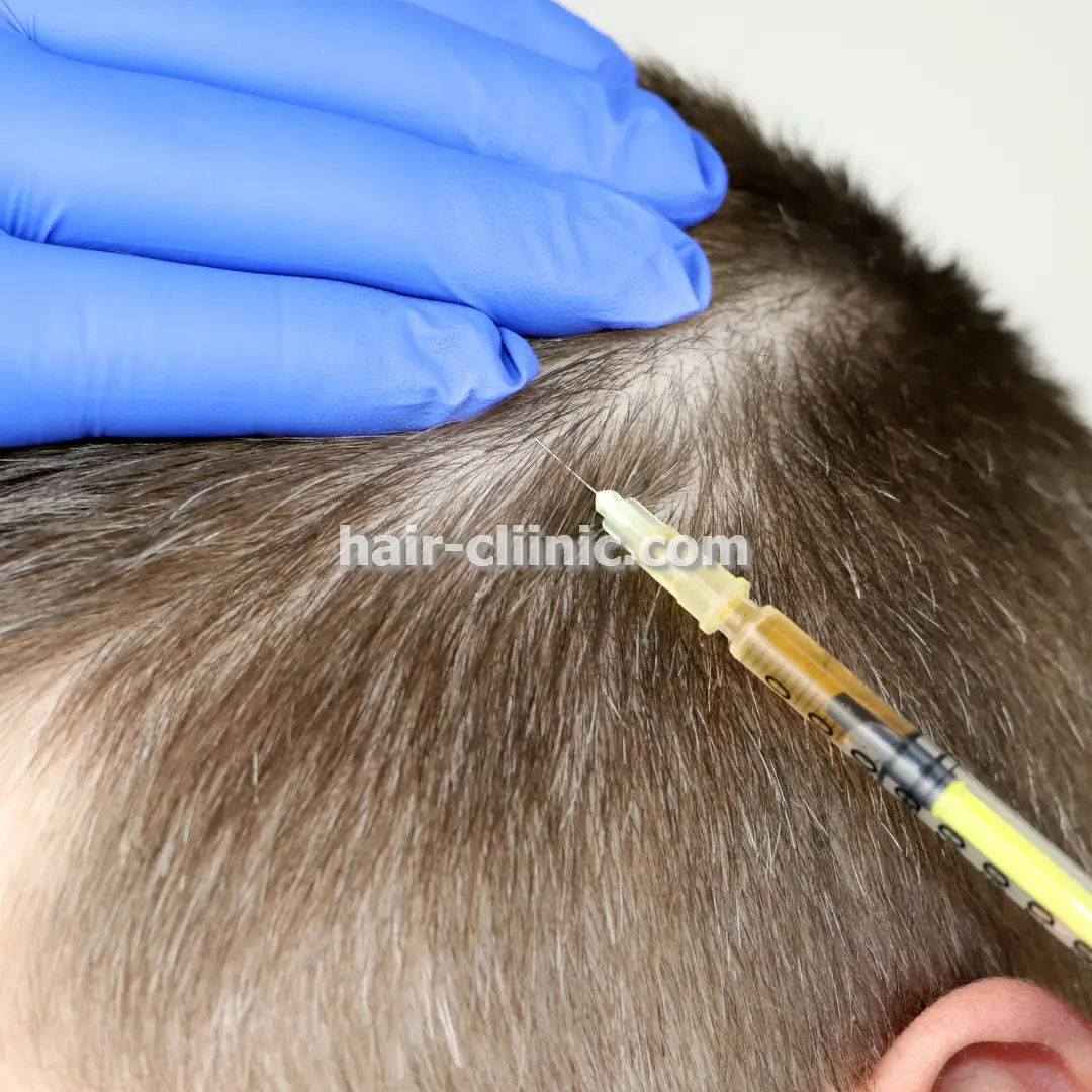 هزینه و قیمت کاشت مو و ابرو در تهران