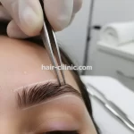 کاشت مو و ابرو با روش های نوین برای مادران در تهران