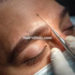 کاشت مو و ابرو با فناوری روز و نتایج طبیعی در تهران